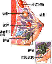 乳腺炎的症状有哪些